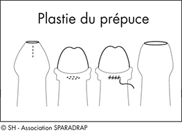 Schéma explicatif de la plastie du prépuce